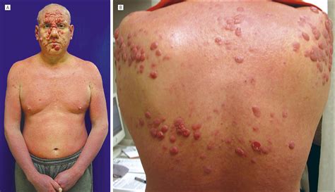 Early Cutaneous T Cell Lymphoma Rash