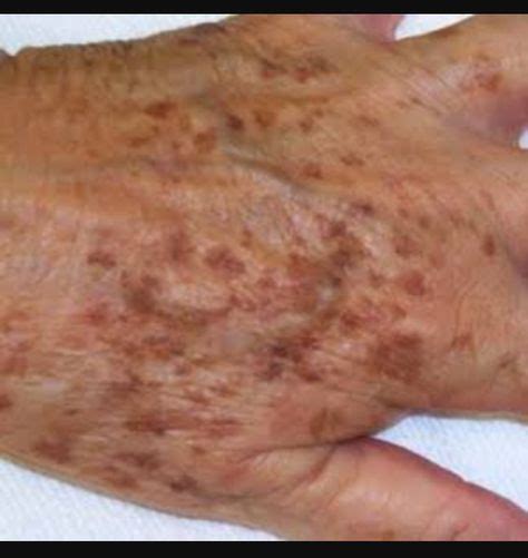 Lentigos Liver Spot Age Spot Removal Brown Spots On Skin