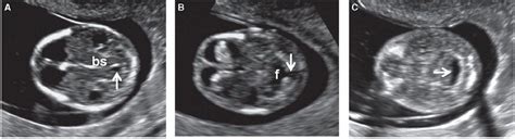 Normal Fetal Ultrasound Survey Radiology Key