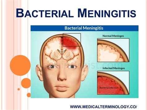 Bacterial Meningitis Causes Symptoms Treatment Ppt