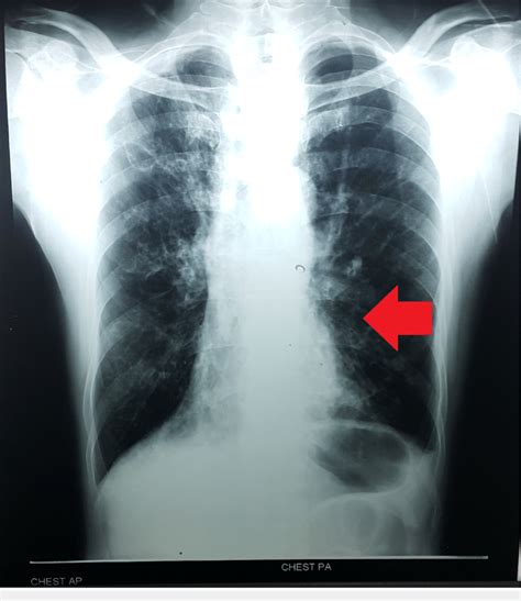 Chest X Ray Showing Mild Cardiomegaly With Pulmonary Congestion And