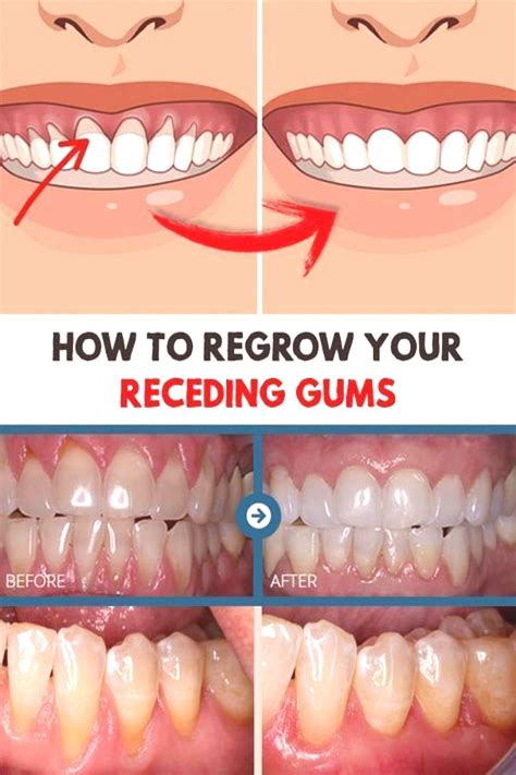 How To Regrow Your Receding Gums In 2020 Receding Gums Gum Care