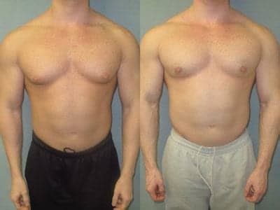 Correction Of Gynecomastia In Bodybuilders A Case Series Of More Than