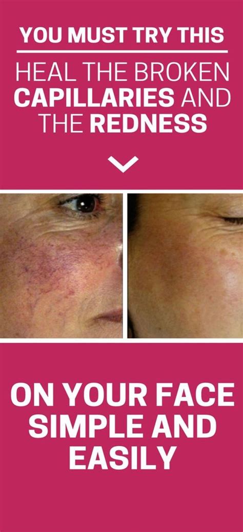 Get Rid Of Redness And Burst Capillaries On The Face Healthy Lifestyle