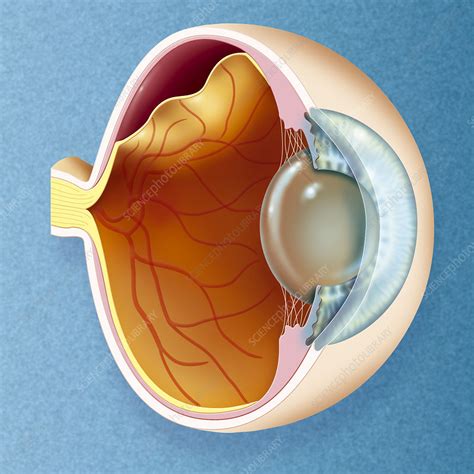 Retinal Detachment Illustration Stock Image C0063662 Science