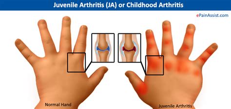 Juvenile Arthritis Ja Or Childhood Arthritissymptomstreatment