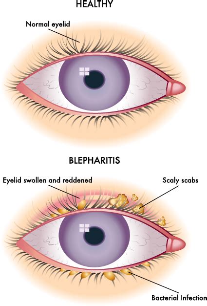 What Is Blepharitis
