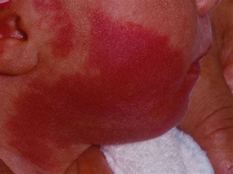 Laser Treatment Of Port Wine Stains In Infancy Found Safe Effective