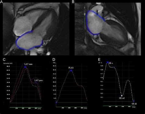 Association Of Left Atrial Function With Incident Atypical Atrial