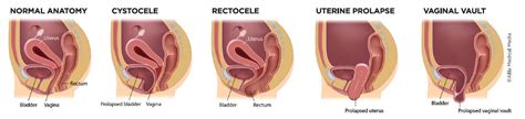 Uterus Prolapse