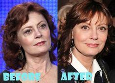 Susan Sarandon Plastic Surgery Before And After Pictures Susan
