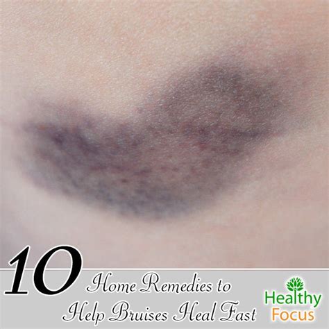 10 Home Remedies To Help Bruises Heal Fast Healthy Focus