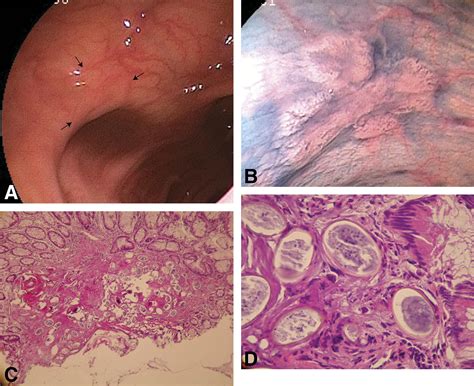 Schistosoma Japonicum Showing Flat Colon Polyp Appearance