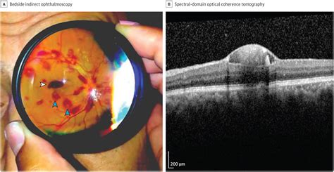 Retinal Hemorrhages In A Patient With Petechiae Retinal Disorders