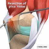 Knee Plica Treatment Pictures