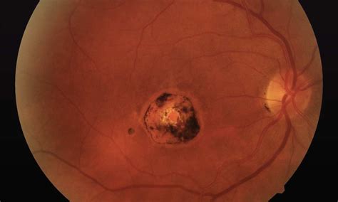Ocular Histoplasmosis Syndrome Bikin Kehilangan Penglihatan