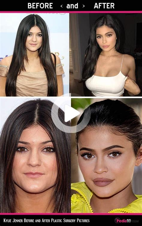 Kylie Jenner Before And After Plastic Surgery Pictures Kylie Jenner