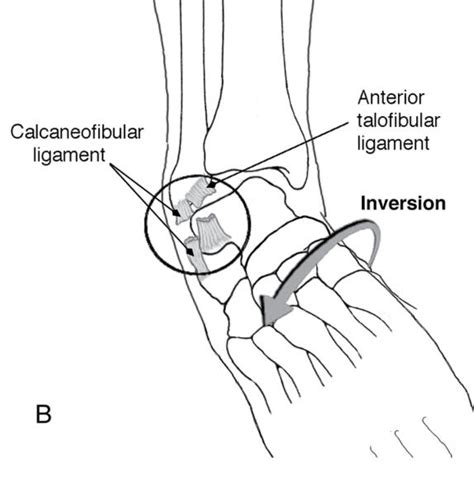 Ankle And Foot Injuries In Dancers Human Kinetics Canada