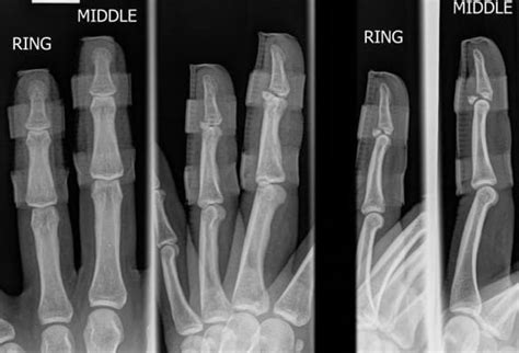 Mallet Finger Fracture