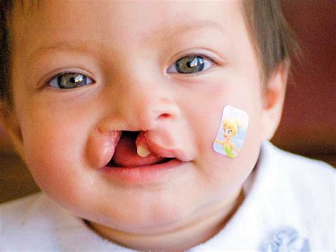 Importance Of Treating Cleft Lip And Palate As Soon As Possible Wide Smiles