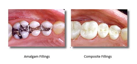 Can I Whiten Teeth With Fillings Poplar Crossing Dental