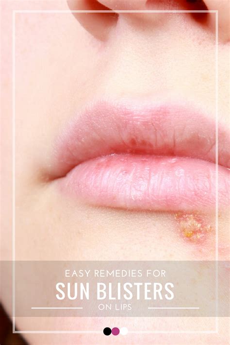 Heres How To Tackle Sun Blisters On Lips Blister On Lip Sun