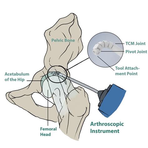 Prototype Of The Proposed Hand Held Hip Arthroscopy Tool Download