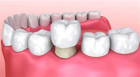 Rehabilitación Oral Clinica Dental Fabián López