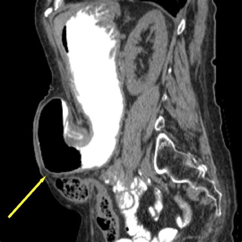 Sagittal View In Abdominal Ct Scan Yellow Arrow Indicates Stomach