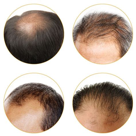 Some may experience itchiness or some pain in the skin before the hair falls off. Hair loss in women & men | Who is Forila for? - Forila