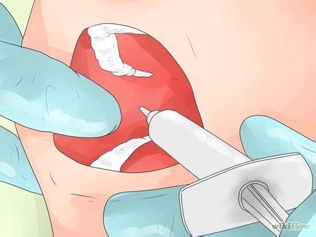 It's prevalent for food to get stuck in the wisdom tooth hole after extraction. How to Remove Food from Extracted Wisdom Teeth Sockets ...