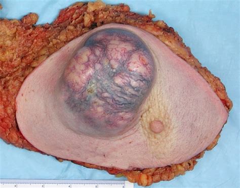 Invasive Ductal Carcinoma Pathophysiology Hot Sex Picture
