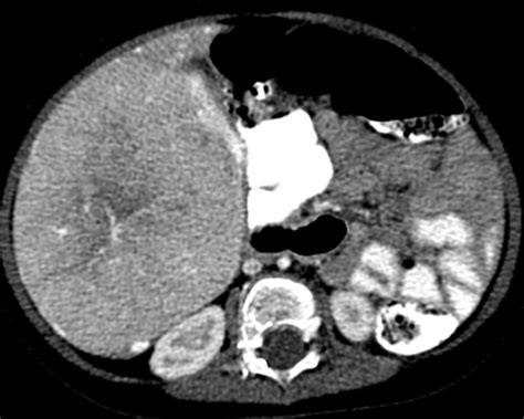 Black Spots On Ct Scan Of Abdomen Ct Scan Machine