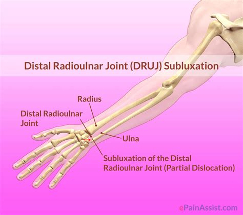 Distal Radioulnar Joint Druj Subluxationtypescausessymptoms