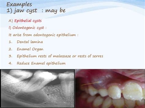 Most Common Dental Cysts In Radiology