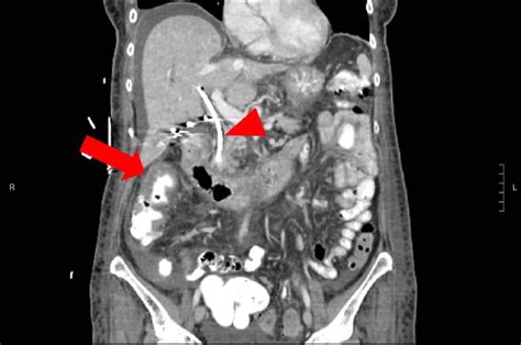 Abdominal And Pelvic Computed Tomography With Intravenous And Oral