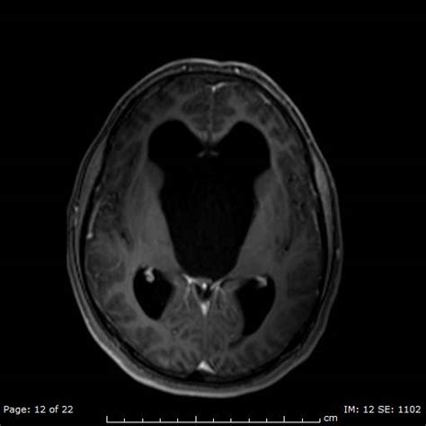 Suprasellar Arachnoid Cyst Image