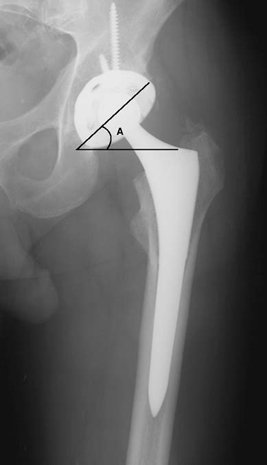 Imaging Of The Hip Teachme Orthopedics