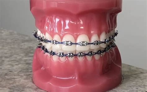 Whizolosophy What Types Of Power Chains Are Available For Braces