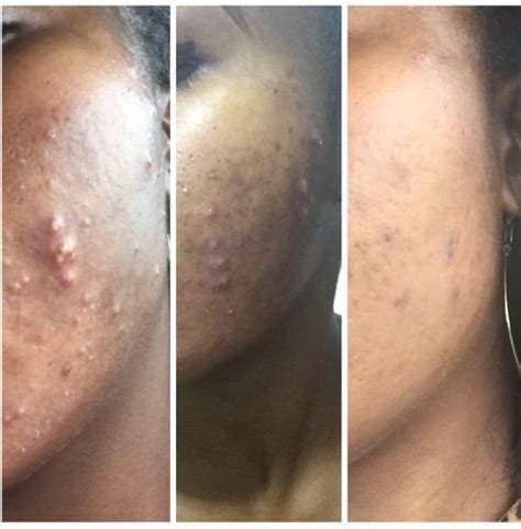 Gbemi O Speaks About Battling Severe Acne And Winning Beautygeek