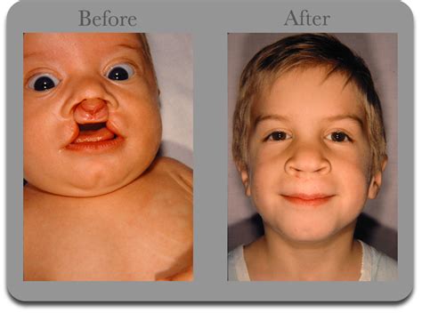 Upper Lip Plastic Surgery Before And After Lips Plastic Surgery Cleft Lip Palate Zucchini