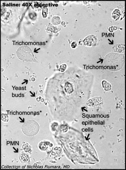 Trichomonas Vaginalis With Images Medical Laboratory Scientist