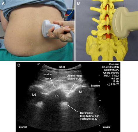 Locating The Epidural Space In Obstetric Patients—ultrasound A Useful