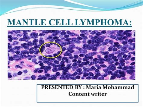 Mantle Cell Lymphoma Ppt