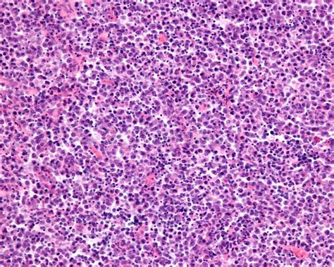 Human Lymph Node Metastasis Of Malignant Melanoma Stock Image Image