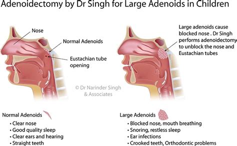 Adenoidectomy Sydney Big Adenoids Sydney Westmead Nsw