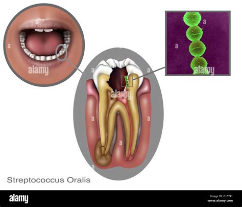Illustration Of An Oral Infection Caused By The Bacteria Stock Photo
