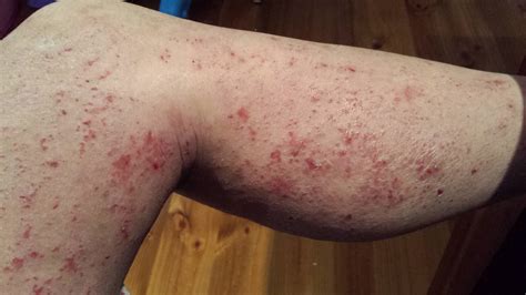 Lymphoma Rash On Legs