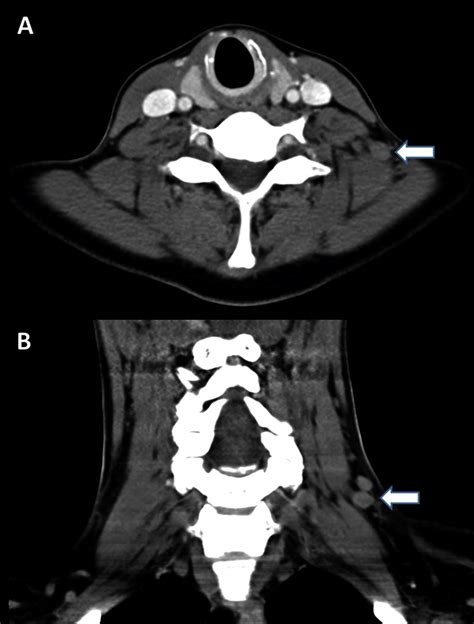 A Soft Tissue Ct Scan Of The Neck Indicated Lymphadenopathy A Axial