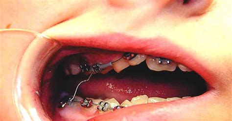 Orthodontics How To Handle Braces Emergencies Wire Poking Sore Teeth My Xxx Hot Girl